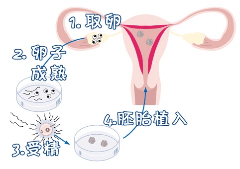 单身试管供卵服务公司试管婴儿中心